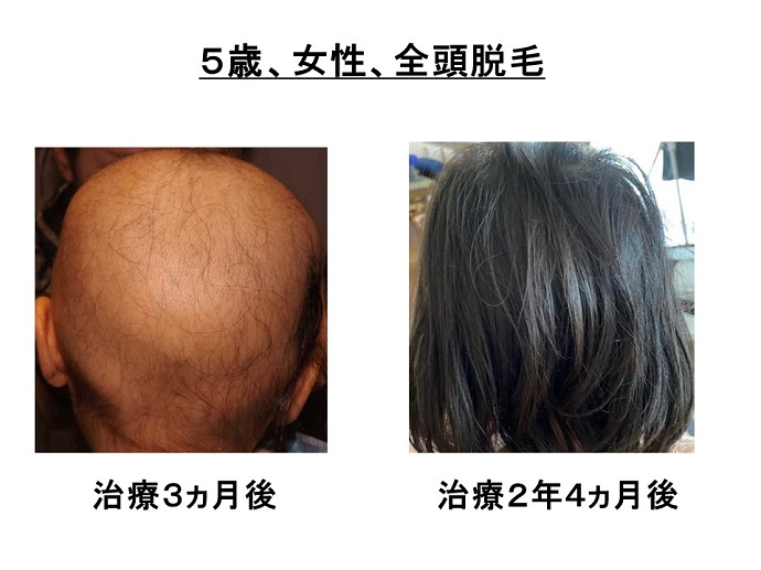 円形脱毛症　病院